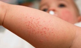 Biến chứng của sởi v&#224; c&#225;ch ph&#242;ng tr&#225;nh