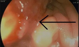 B&#233; trai 15 tuổi đ&#227; mắc ung thư đại tr&#224;ng, l&#224;m g&#236; để ph&#242;ng tr&#225;nh?