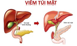 6 huyệt vị hỗ trợ điều trị vi&#234;m t&#250;i mật