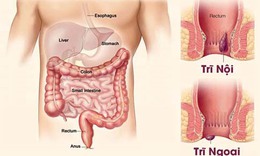 Bệnh trĩ đ&#226;u c&#242;n l&#224; nỗi lo - giải ph&#225;p hỗ trợ từ thảo dược tự nhi&#234;n