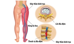 Đau thần kinh tọa c&#243; thể điều trị khỏi ho&#224;n to&#224;n kh&#244;ng?