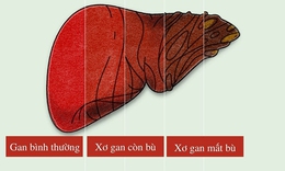 Triển vọng điều trị xơ gan cổ trướng bằng tế b&#224;o gốc tự th&#226;n