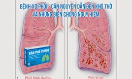 Bệnh xơ phổi – Căn nguy&#234;n dẫn đến kh&#243; thở v&#224; những biến chứng nguy hiểm