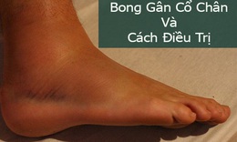 Chữa bong g&#226;n bằng thuốc nam