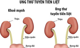 Ung thư tuyến tiền liệt v&#224; những hiểu lầm thường gặp