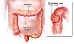 Giảm nguy cơ ung thư đại trực tr&#224;ng bằng th&#243;i quen l&#224;nh mạnh