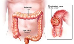 Statin c&#243; thể l&#224;m chậm qu&#225; tr&#236;nh ung thư di căn