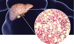 Liệu ph&#225;p mới c&#243; thể gi&#250;p điều trị bệnh gan nhiễm mỡ kh&#244;ng do rượu