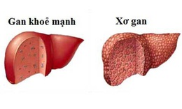 Xơ gan: Nguy&#234;n nh&#226;n, ph&#226;n loại v&#224; chẩn đo&#225;n điều trị