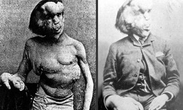 Hội chứng người voi: Nguyên nhân, triệu chứng và biện pháp điều trị