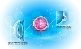 Điều trị gl&#244;c&#244;m dưới g&#243;c nh&#236;n của chuy&#234;n gia    