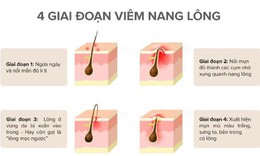 Viêm nang lông chữa thế nào?