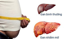 Bị gan nhiễm mỡ c&#243; n&#234;n uống thuốc bổ gan?