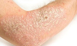 Tiềm năng của nh&#243;m thuốc mới trong điều trị vi&#234;m da cơ địa