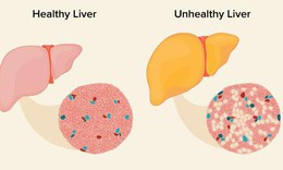 Ngăn ngừa v&#224; điều trị gan nhiễm mỡ bằng thay đổi lối sống