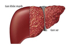 B&#236;nh v&#244;i, vị thuốc hỗ trợ điều trị xơ gan