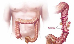 Vi&#234;m t&#250;i thừa đại tr&#224;ng: Xử l&#253; thế n&#224;o?