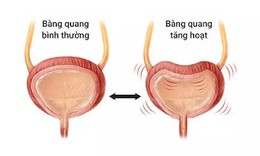 B&#224;ng quang tăng hoạt: chứng bệnh kh&#244;ng chỉ g&#226;y phiền to&#225;i