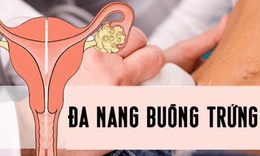 Đa nang buồng trứng v&#224; nguy biến kh&#243; lường