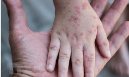 Thêm nhiều quốc gia ghi nhận ca bệnh đậu mùa khỉ 