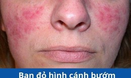 Bệnh lupus ban đỏ v&#224; c&#225;ch hỗ trợ giảm nguy cơ tiến triển từ thảo dược