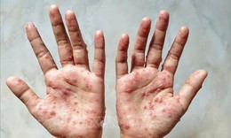 Thủ tướng: Phòng chống bệnh đậu mùa khỉ 'sớm hơn một bước, cao hơn một mức'