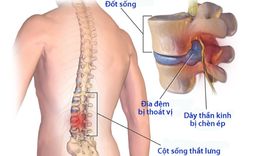 Khắc phục những cơn đau d&#226;y thần kinh li&#234;n sườn