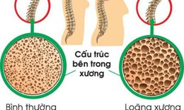 3 c&#225;ch gi&#250;p ngăn ngừa lo&#227;ng xương sau m&#227;n kinh