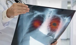 Ung thư phổi liệu c&#243; di truyền?