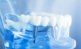 Giải ph&#225;p tối ưu trong trồng răng Implant