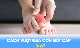 Giải ph&#225;p gi&#250;p giảm đau cơn g&#250;t cấp an to&#224;n v&#224; hiệu quả