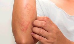 Viêm da cơ - Viêm đa cơ: Nguyên nhân, triệu chứng và cách phòng tránh