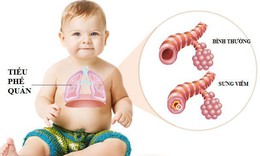 Vi&#234;m tiểu phế quản cấp ở trẻ: Con đường l&#226;y nhiễm v&#224; c&#225;ch điều trị