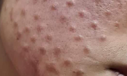 Da nổi u hạt sau khi ti&#234;m mesotherapy bằng hoạt chất kh&#244;ng r&#245; nguồn gốc