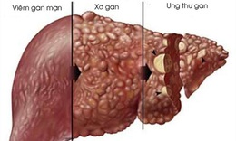 Người mắc bệnh vi&#234;m gan B n&#234;n tr&#225;nh xa loại đồ uống n&#224;y để ngăn ngừa biến chứng nguy hiểm