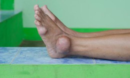 Cảnh b&#225;o 3 biến chứng gout nguy hiểm