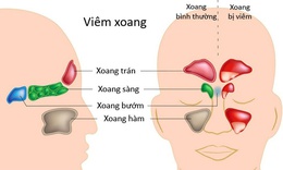 Vi&#234;m xoang cấp t&#237;nh nung mủ ai dễ mắc?