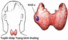 Chuy&#234;n gia lưu &#253; về chế độ ăn cho người bệnh ung thư tuyến gi&#225;p