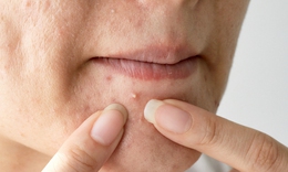 7 sai lầm trong điều trị mụn trứng cá, khiến bệnh trở nặng