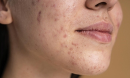 Các thuốc điều trị mụn viêm, mụn thâm