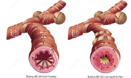 Bệnh hen nếu mắc th&#234;m c&#225;c bệnh n&#224;y sẽ khiến t&#236;nh trạng hen nặng hơn