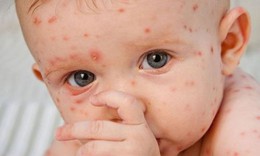 Dự ph&#242;ng bệnh sởi cho trẻ trong m&#249;a đ&#244;ng xu&#226;n
