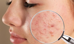 Khi n&#224;o cần d&#249;ng thuốc uống trị mụn trứng c&#225;?