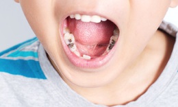 S&#226;u răng ở trẻ g&#226;y nhiều t&#225;c hại hơn cha mẹ nghĩ