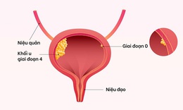 Tiểu ra máu, cảnh báo ung thư bàng quang và những dấu hiệu cần biết