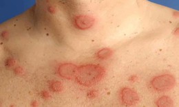 Người mắc lupus ban đỏ c&#243; phẫu thuật thẩm mỹ được kh&#244;ng?