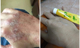 Chọn kem bôi da không chứa corticoid