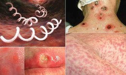 Dự ph&#242;ng l&#226;y nhiễm giang mai v&#224; HIV