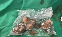 Tắc ruột vì ăn hồng ngâm, cô gái 23 tuổi phải nhập viện cấp cứu

