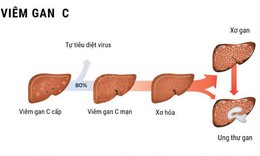 Điều trị tốt vi&#234;m gan C ở người nhiễm HIV gi&#250;p giảm tỉ lệ tử vong